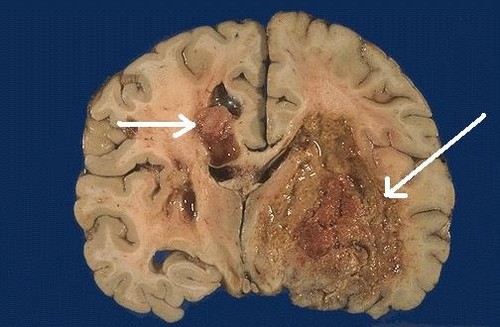 Tumor cerebral