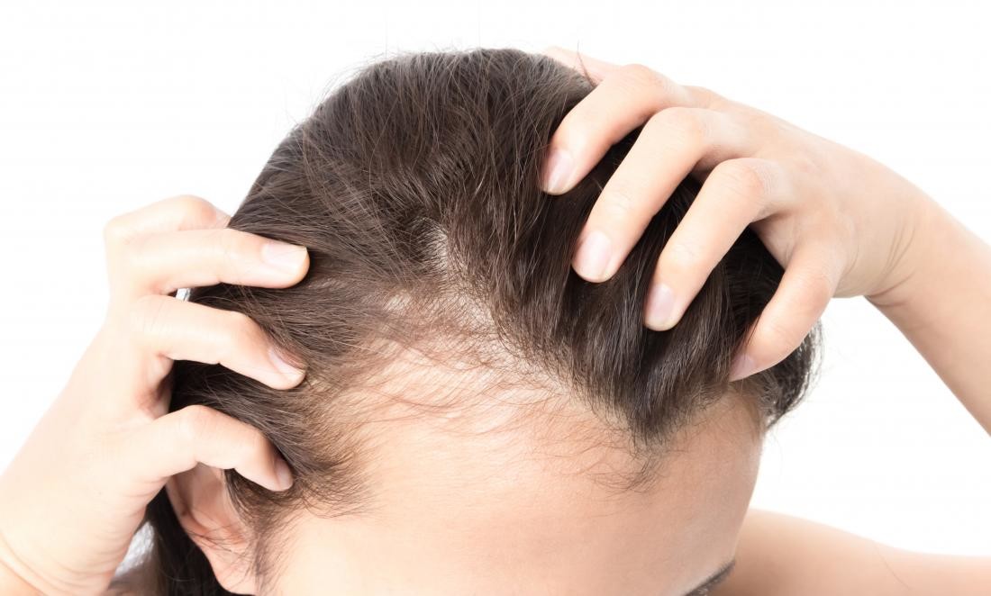 Socorro! Estou a ficar careca! - A Alopécia Androgenética Feminina