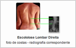 escoliose c rx.png